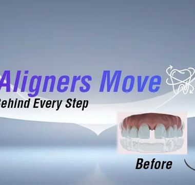 How Clear Aligners Move Teeth - Oblu